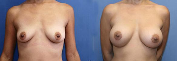 B cup size to a full C cup size with silicone breast implants.